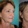 How to Achieve Natural-Looking Results with Cosmetic Treatments