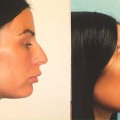 Exploring Rhinoplasty: A Guide to Enhancing Your Appearance