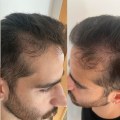 Understanding Hair Transplant Procedures