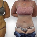 Tummy Tuck in Glasgow: What You Need to Know