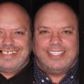 Exploring the Positive and Negative Aspects of Cosmetic Treatments in Glasgow