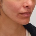 Understanding Dermal Fillers: A Guide to Non-Invasive Facial Treatments in Glasgow