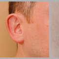 A Look into Ear Surgery: Options for Cosmetic Treatment in Glasgow