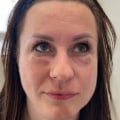 Possible Risks and Complications of Cosmetic Treatments in Glasgow