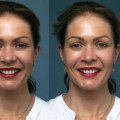Tips for Perfect Lighting, Angles, and Editing in Cosmetic Treatment Photography