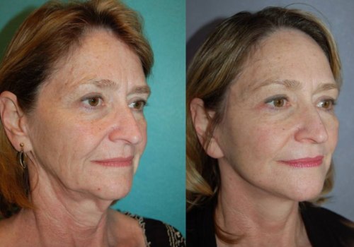 How to Achieve Natural-Looking Results with Cosmetic Treatments