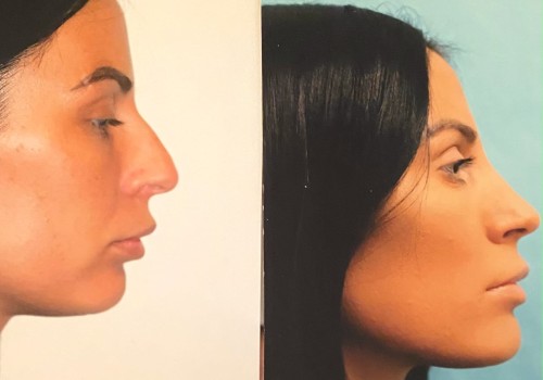 Exploring Rhinoplasty: A Guide to Enhancing Your Appearance