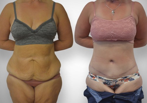 Tummy Tuck in Glasgow: What You Need to Know