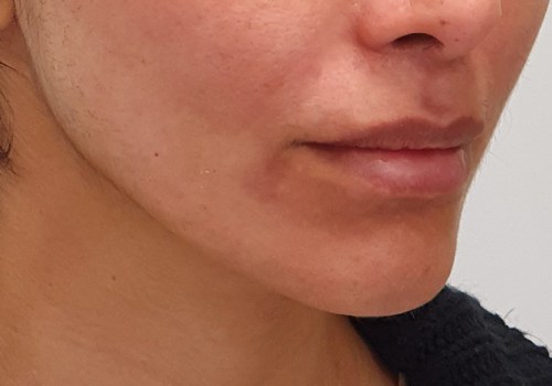 Understanding Dermal Fillers: A Guide to Non-Invasive Facial Treatments in Glasgow