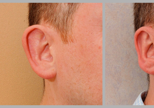 A Look into Ear Surgery: Options for Cosmetic Treatment in Glasgow