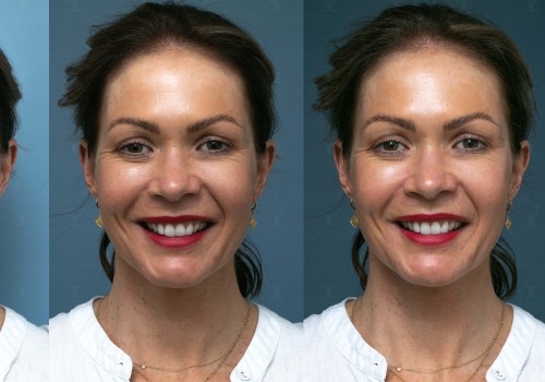 Tips for Perfect Lighting, Angles, and Editing in Cosmetic Treatment Photography